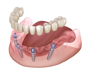 Dental implant with screws and abutments, showcasing a dental prosthetic device.