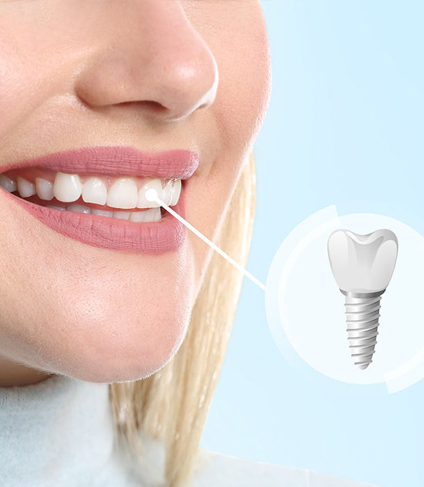 The image shows a close-up of a person s face with a focus on their teeth, which are highlighted by a dental implant. The person is smiling and appears to be wearing a clear aligner for orthodontic treatment.