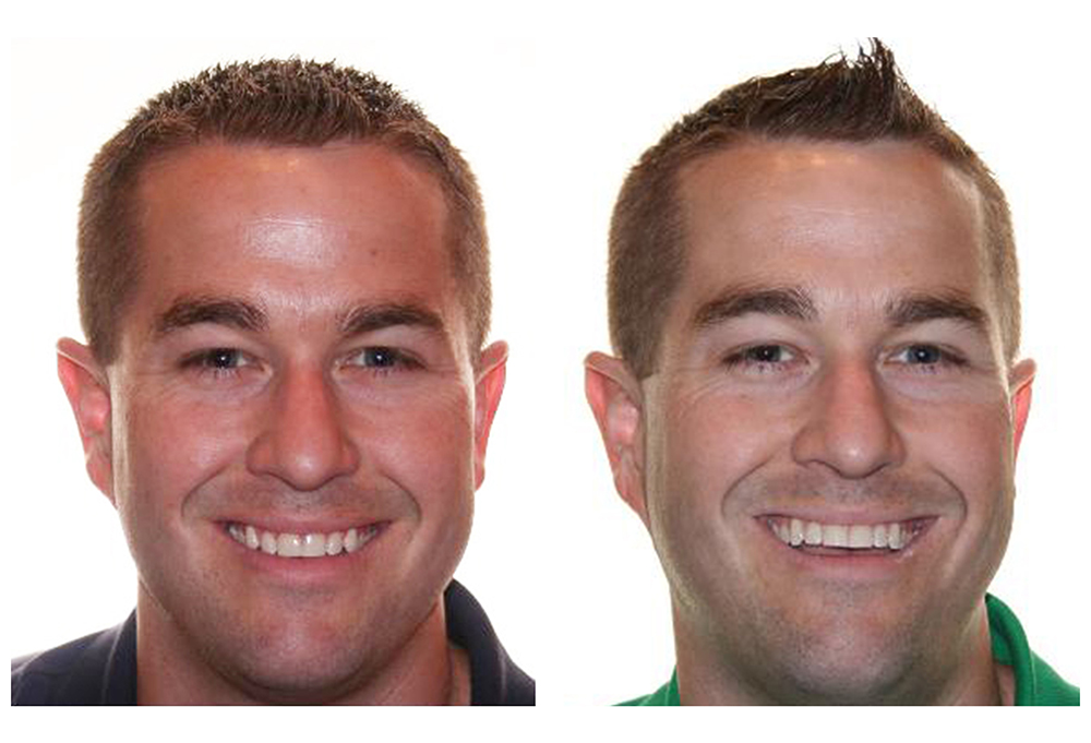 Crowns Now Family Dentistry