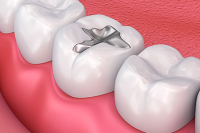 The image shows a close-up of a dental implant in the upper jaw, surrounded by artificial teeth.