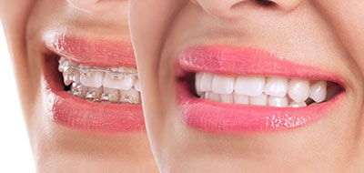 The image is a composite of two photographs, showing a woman s face with a smile and teeth from different angles.