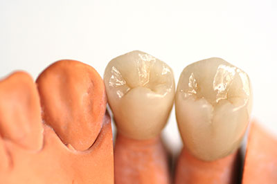 The image shows a set of human teeth with visible enamel and root surfaces, placed against a white background.