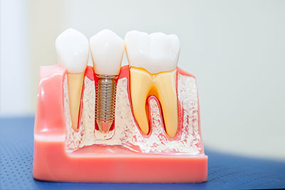 An image of a dental model with various teeth, including a tooth with a visible screw and gumline, showcasing dental implantation technology.