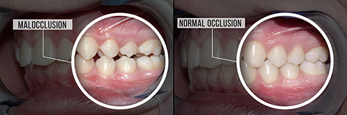 The image shows a side-by-side comparison of a person s teeth before and after dental work, with a focus on the removal of teeth and the resulting gap in the mouth.