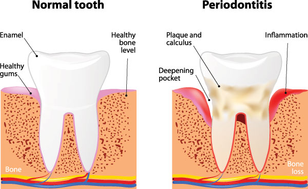 The image is a detailed scientific diagram illustrating the stages of tooth decay, from normal to advanced gum disease, with labels such as  Periodontitis,   Healthy Gums,  and  Bone Loss.