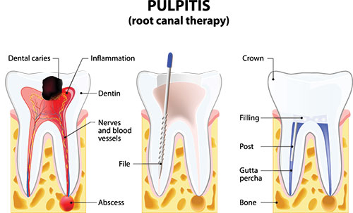 The image is a medical illustration showing the structure of a tooth and its root canal, with labels indicating different parts such as  dental caries,   crown,  and  filling.