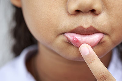 The image shows a close-up of a person s face with a focus on a red, swollen area on the lower lip.