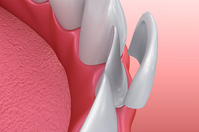 An image of a close-up view of a dental implant with visible screws and a pink, textured background that resembles gum tissue.