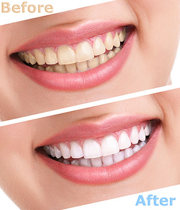 The image shows a smiling person with a before and after comparison of their teeth, demonstrating the results of dental whitening treatment.