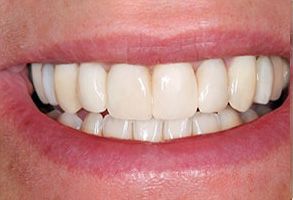 The image shows a close-up of a person s smile, revealing straight white teeth and a clean mouth.