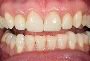 The image is a close-up photograph of a person s mouth displaying a set of teeth with some yellowing and staining, particularly on the lower front teeth.
