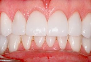 The image shows a close-up of a person s teeth, with the focus on a set of white teeth that are well-maintained and clean.