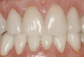 The image shows a close-up of a person s teeth with a focus on a large gap between the front teeth.