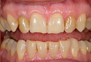 The image shows a close-up of a person s teeth with visible staining and discoloration, which may indicate the need for dental care or cosmetic treatment.