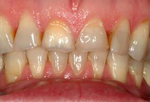 Unhealthy teeth with yellow and brown stains, showcasing a need for dental care.