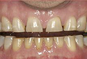 The image shows a close-up of a person s teeth with a yellowish tint, possibly indicating staining or discoloration.